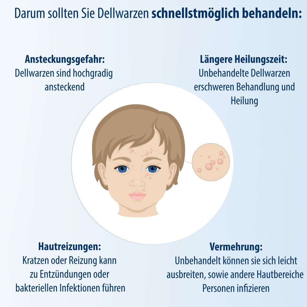 Grafiek met een kind. Bijschrift: Daarom moet u molluscum contagiosum zo snel mogelijk behandelen: besmettingsgevaar, huidirritatie, vermeerdering.