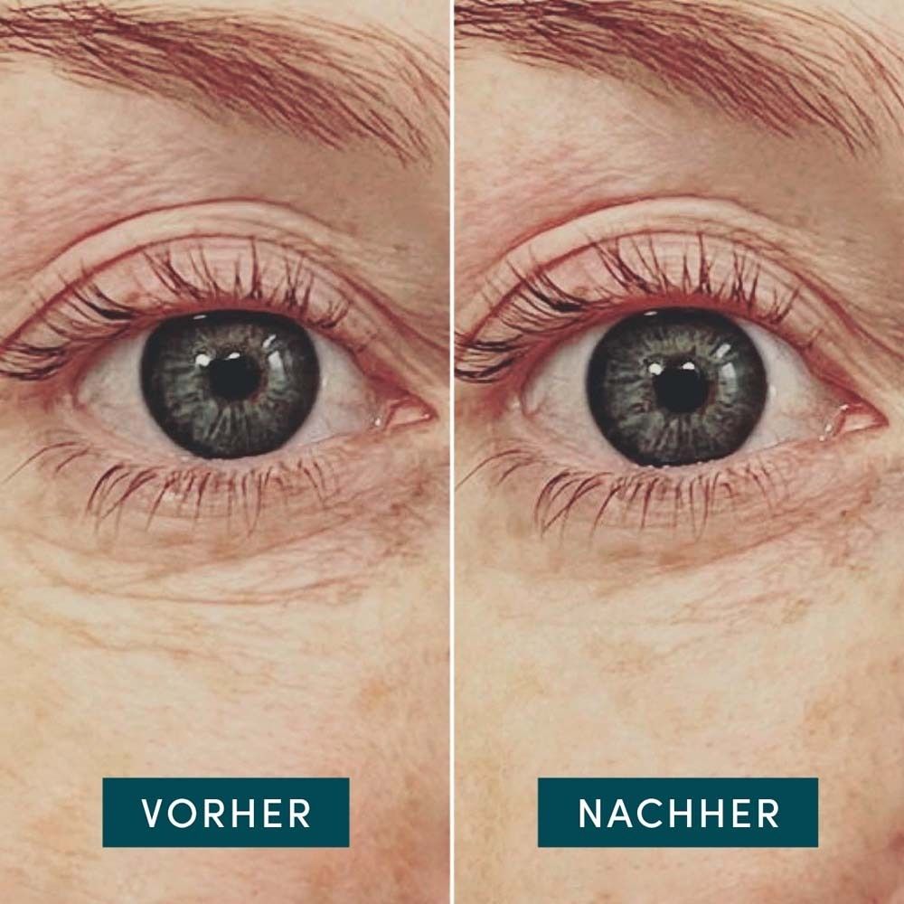 Voor-en-na vergelijking van oogcontouren. Links: Voor, rechts: Na. Tekst: Voor, Na.