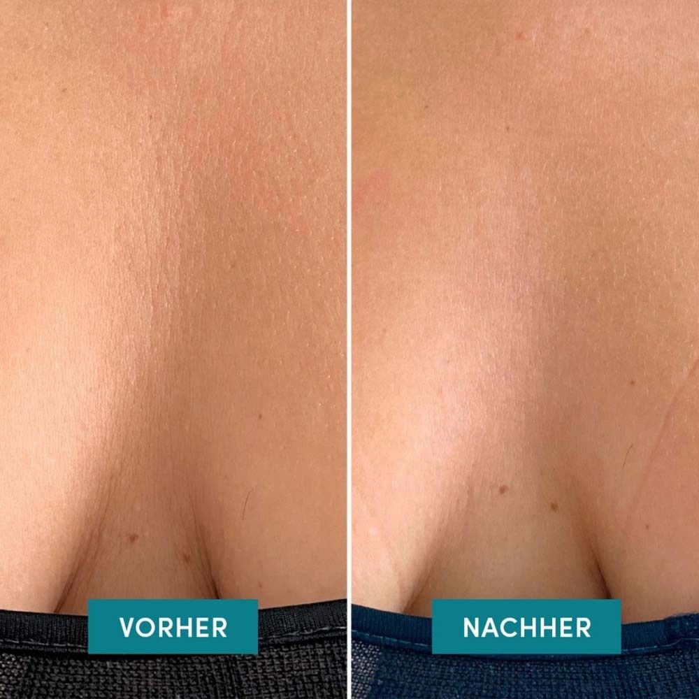 Voor-en-na vergelijking: decolleté met rimpels, dan gladder.