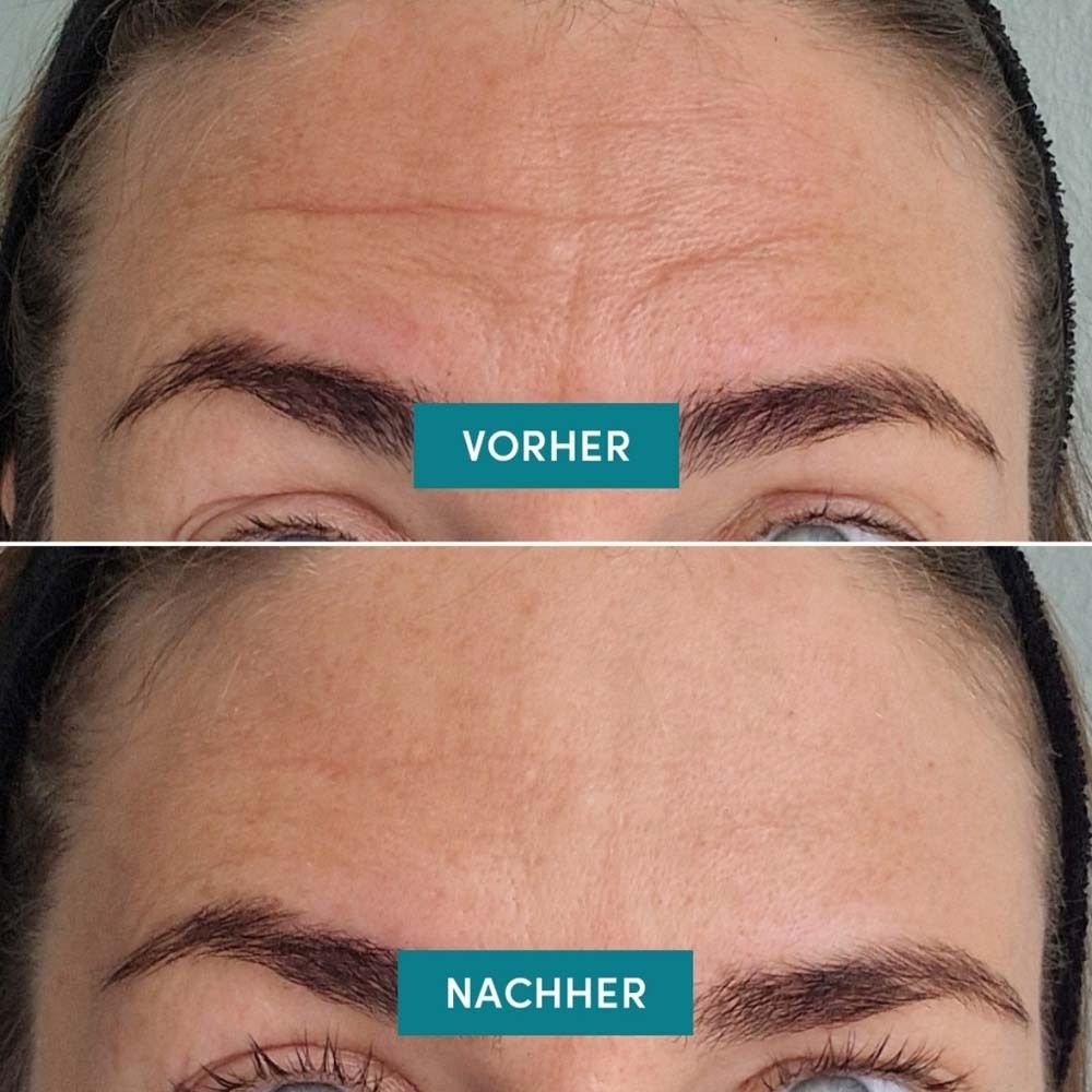 Voor-en-na vergelijking. Twee foto's van voorhoofdsrimpels. Boven: Voor. Onder: Na. Tekst in turquoise.