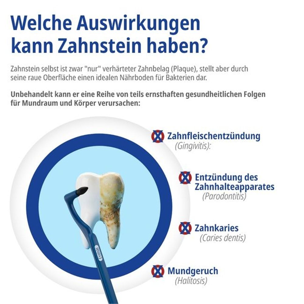 Le tartre peut causer gingivite, parodontite, caries dentaires et mauvaise haleine. Représentation d'une dent avec tartre et instrument.
