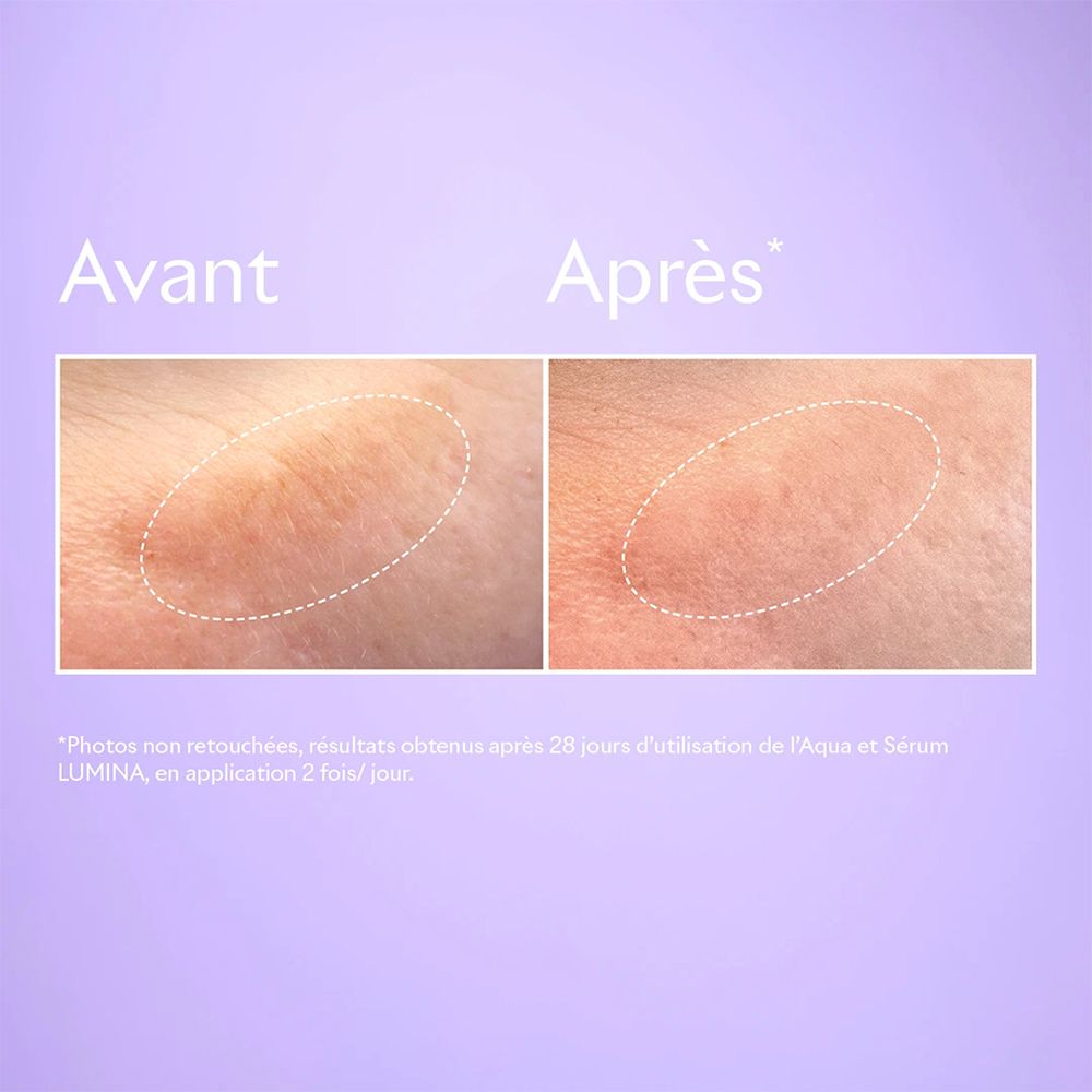 Voor-en-na-afbeelding. Huid met vlekken, dan verbeterde huid.