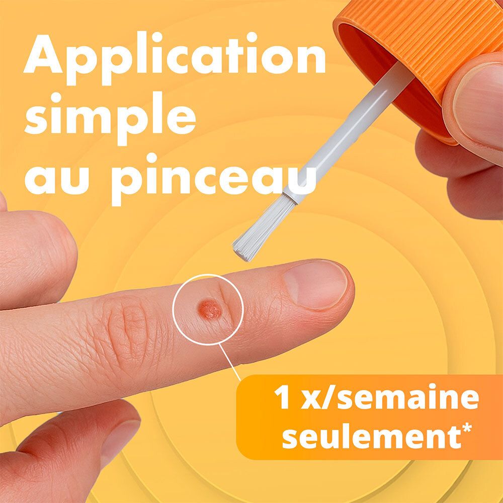 Applicateur à pointe pinceau appliqué sur une verrue. Utilisation une fois par semaine.