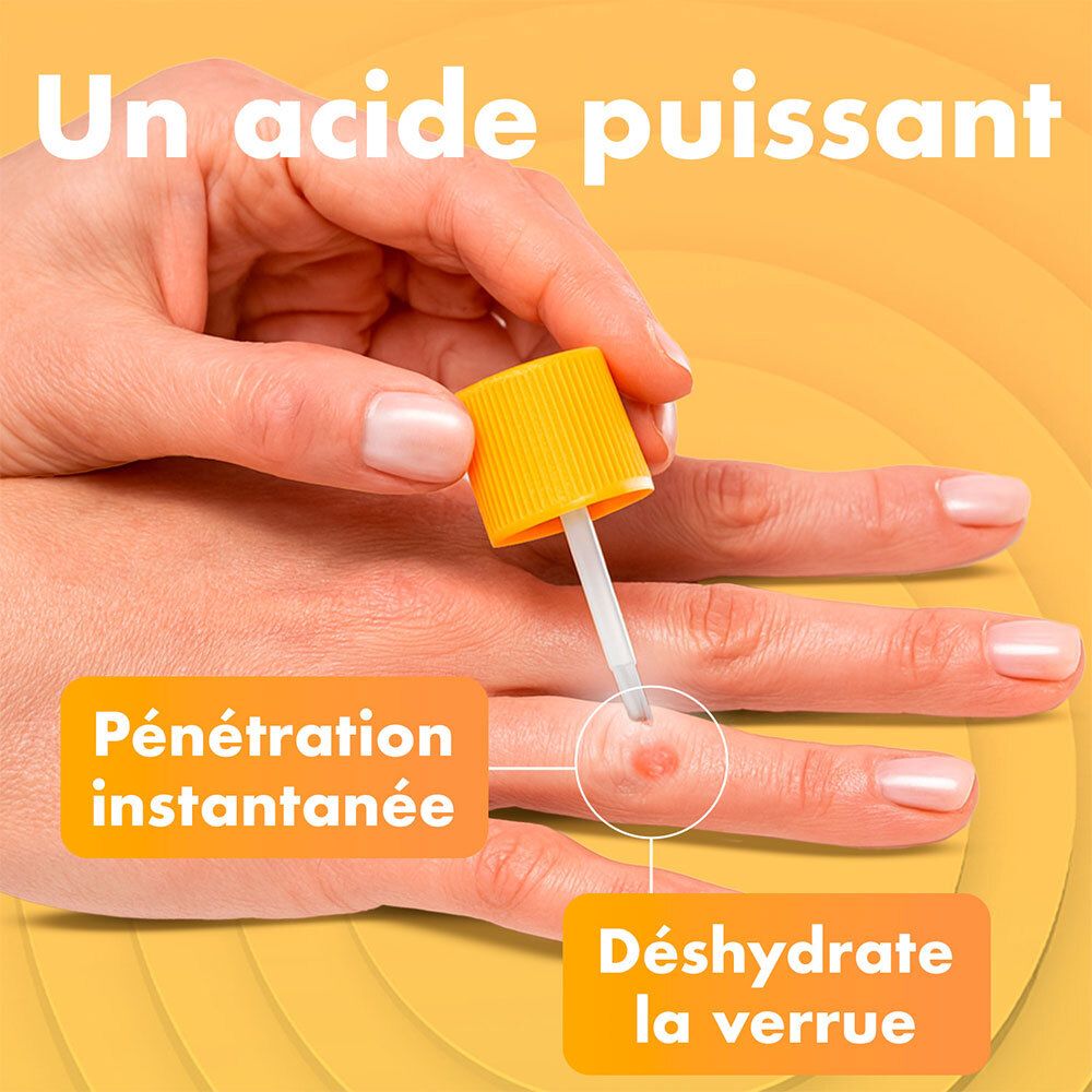 Applicateur à pointe pinceau sur une main. Pénétration instantanée, déshydrate la verrue.