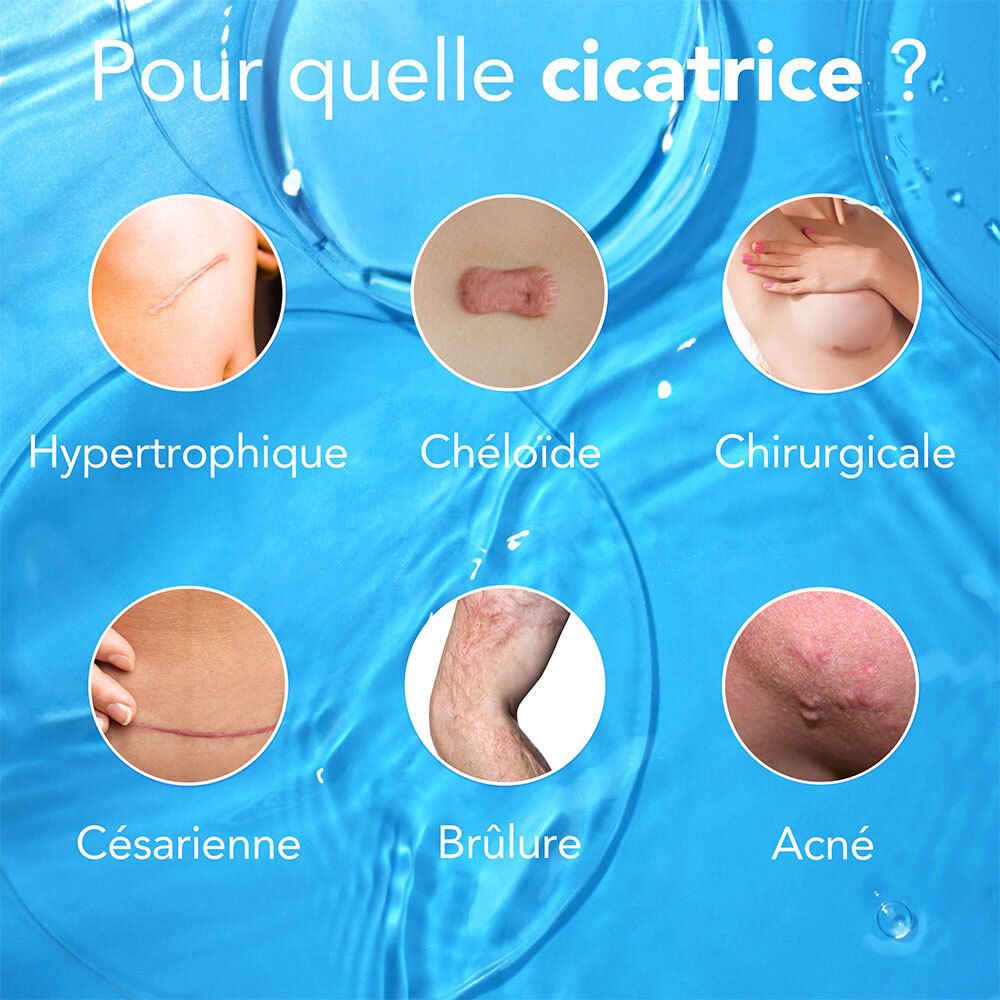 Kelo-Cote Gel, tube. Voor littekens: hypertrofisch, keloïd, chirurgisch, keizersnede, brandwonden, acne.