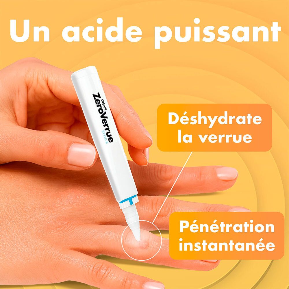 Stylo d'élimination des verrues appliqué sur la main. Acide formique.