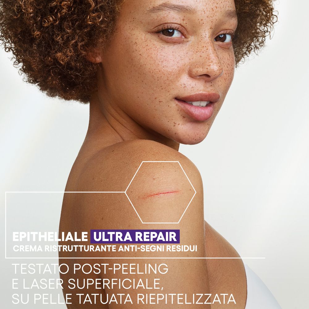 Femme avec imperfections cutanées. Texte : Epitheliale Ultra Repair, Crème Ristrutturante Anti-Segni Residui. Testé après peeling.