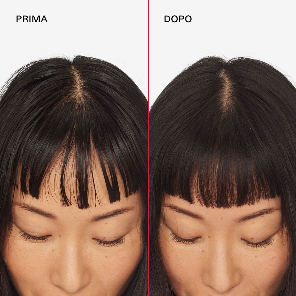 Voor-en-na vergelijking van de haarlijn van een vrouw met donker haar.