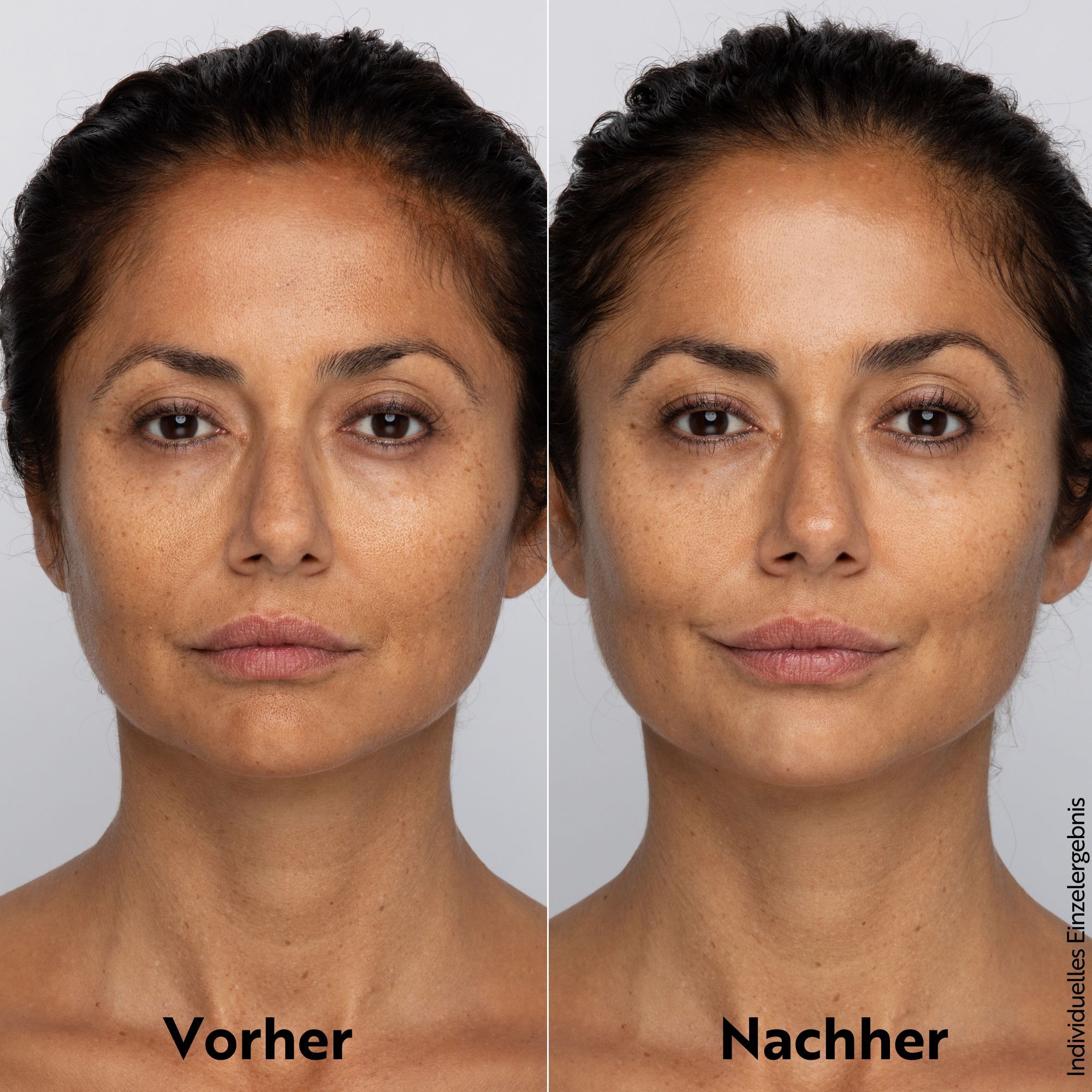 Voor-na vergelijking. Vrouw met huidonzuiverheden links, gladde huid rechts. Tekst: Voor, Na.
