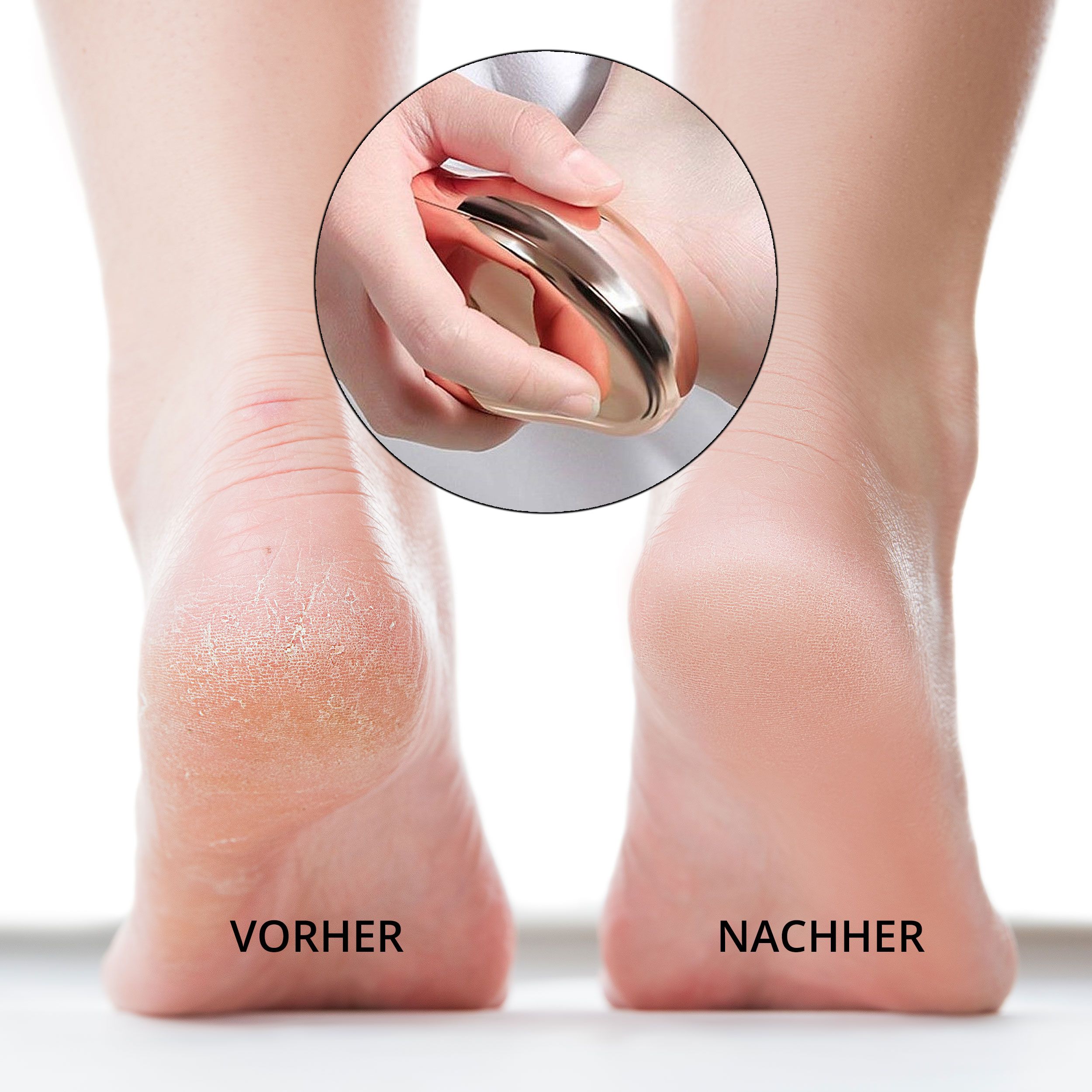 Pieds avant et après traitement. En cercle: appareil de soin des pieds en cours d'utilisation.