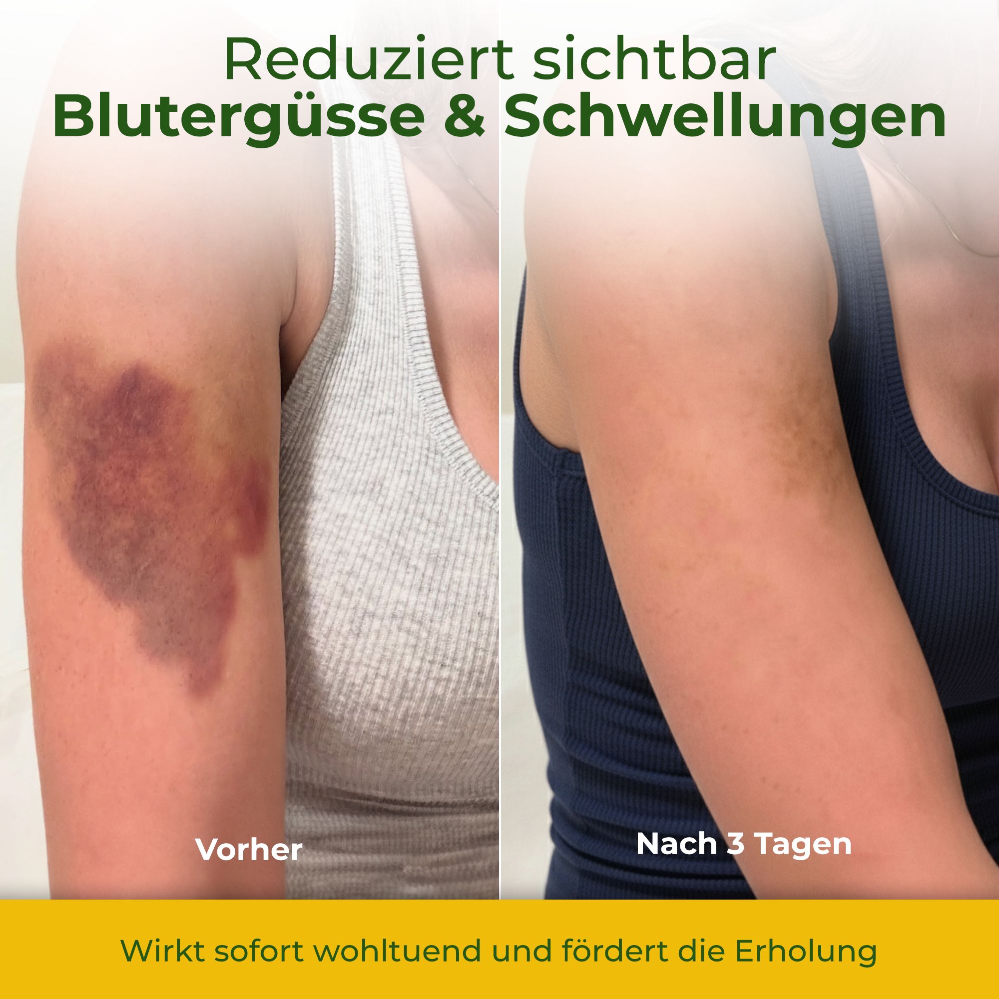 Voor-na vergelijking. Arm met blauwe plek, dan minder na 3 dagen. Tekst: Vermindert blauwe plekken en zwellingen.