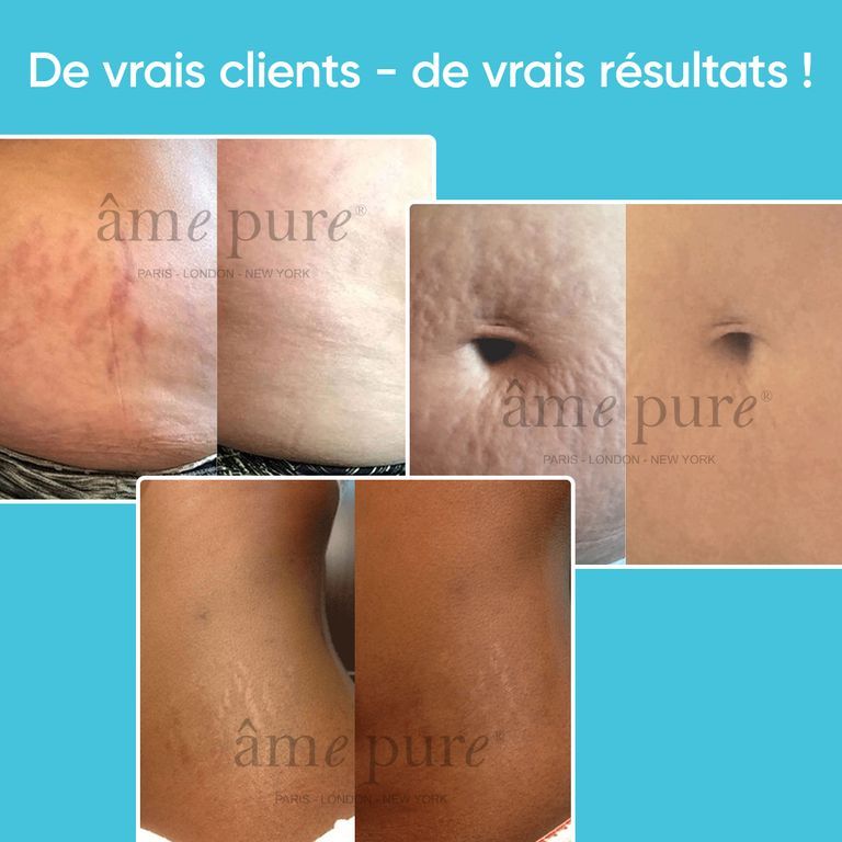 Gros plan d'un rouleau à tête bleue et d'une bouteille de gel argentée.