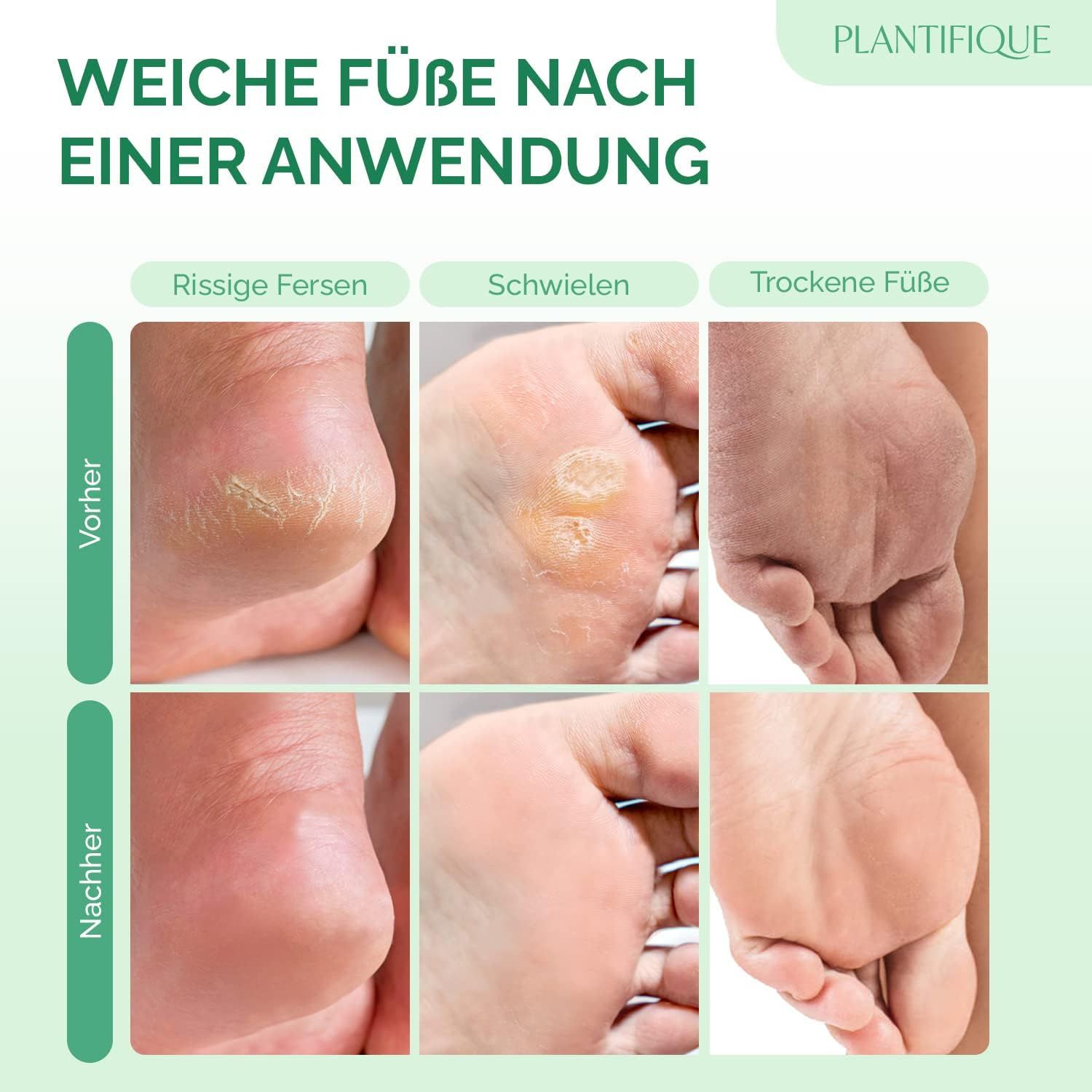 Comparaison avant-après. En haut : talons fendillés, callosités, pieds secs. En bas : talons lisses, pieds lisses, pieds lisses.