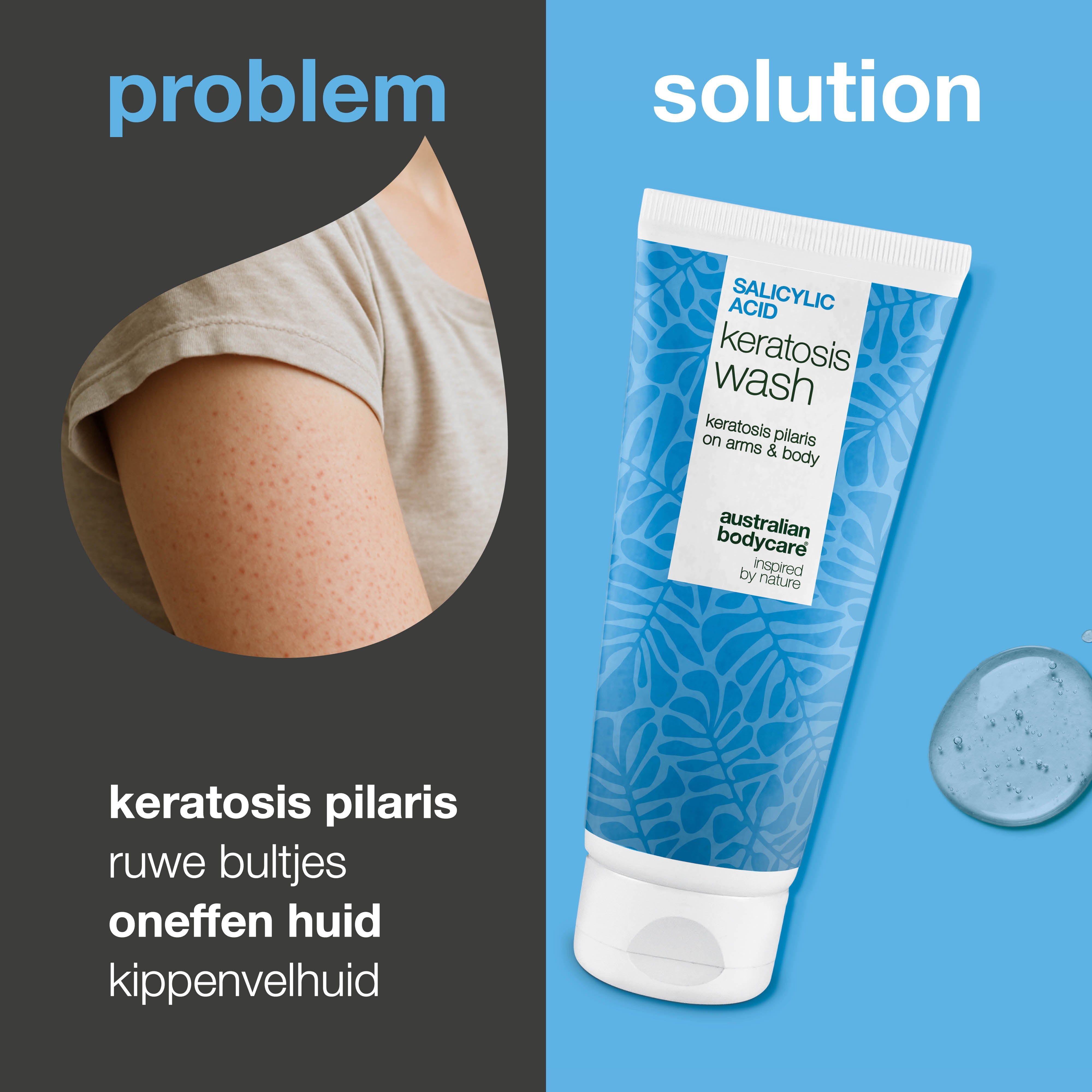 Vergelijking: arm met huidonzuiverheden en tube. Tekst: Salicylic Acid Keratosis Wash. Merk: Australian Bodycare.