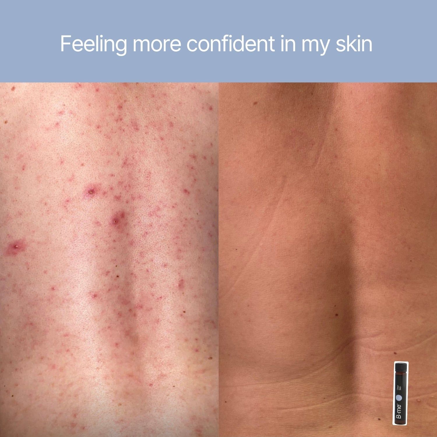 Rug met acne voor en na gebruik. Een ampul met B.me®-logo is rechtsonder te zien.