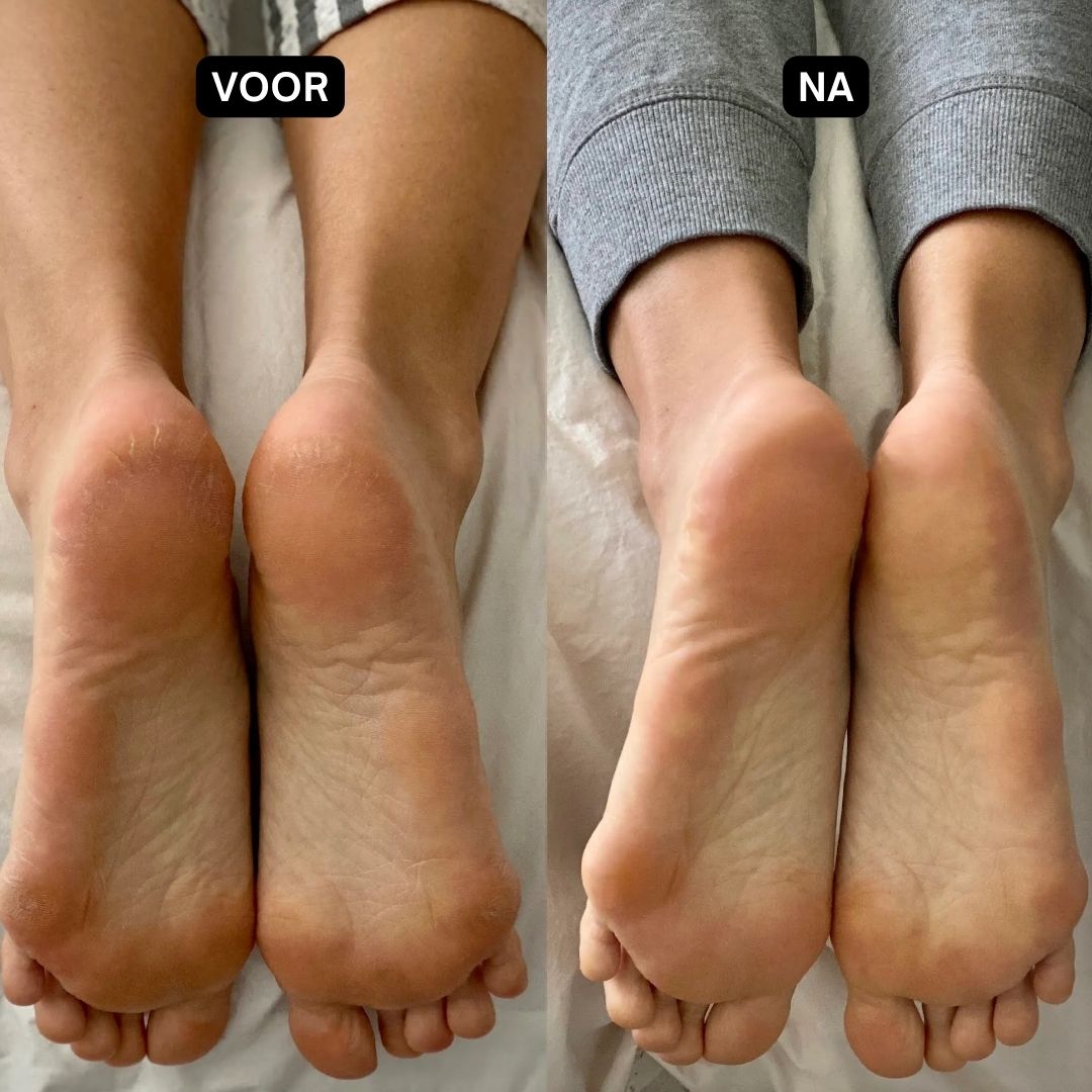 Voor-na vergelijking van voeten. Links: gebarsten hielen. Rechts: gladde voeten. Tekst: Voor, Na.
