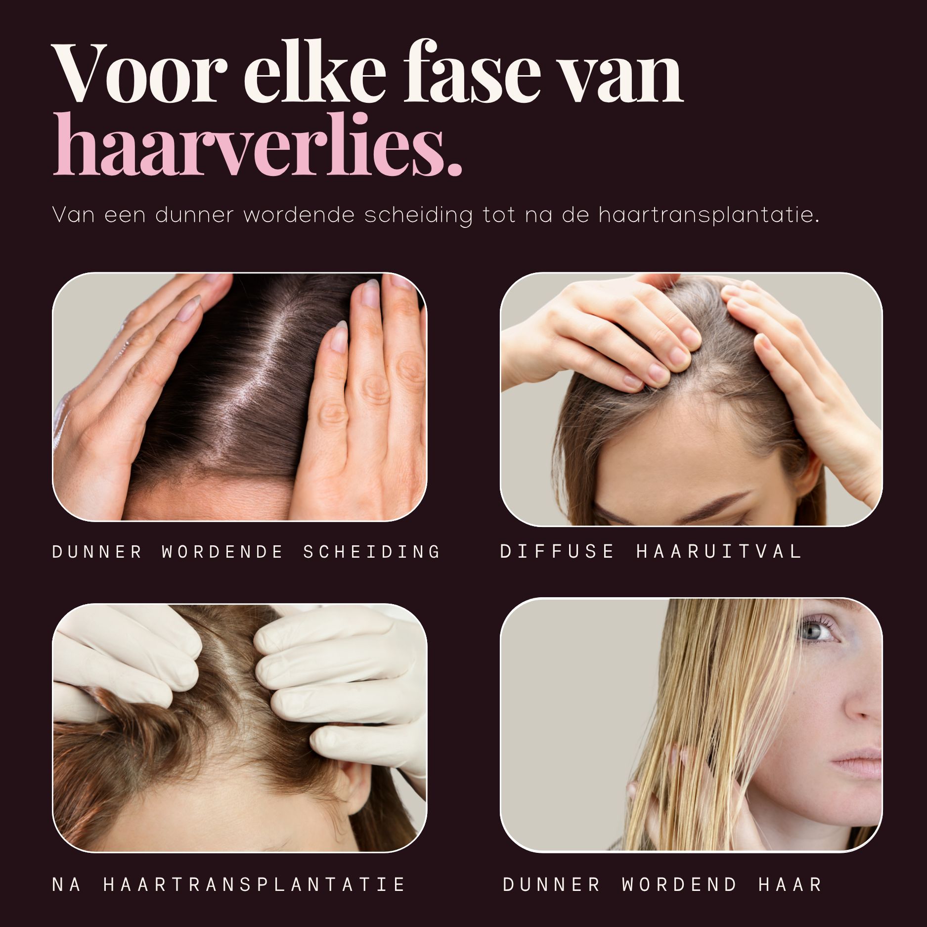 Vier fasen van haaruitval: dunnere scheiding, diffuus haarverlies, na transplantatie, dunner wordend haar.