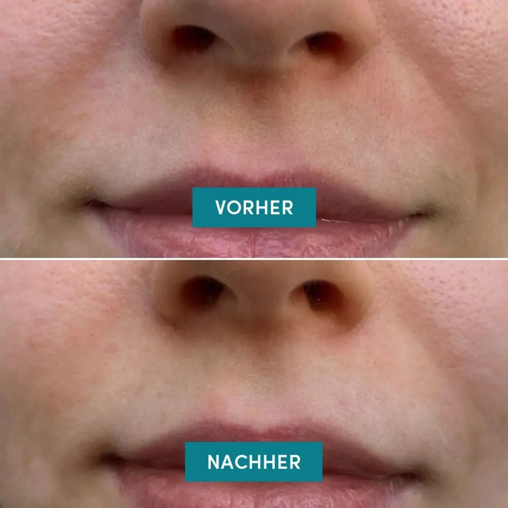 Voor-en-na vergelijking van lippen. Bovenste rij: voor. Onderste rij: na. Tekst: mouth patches.