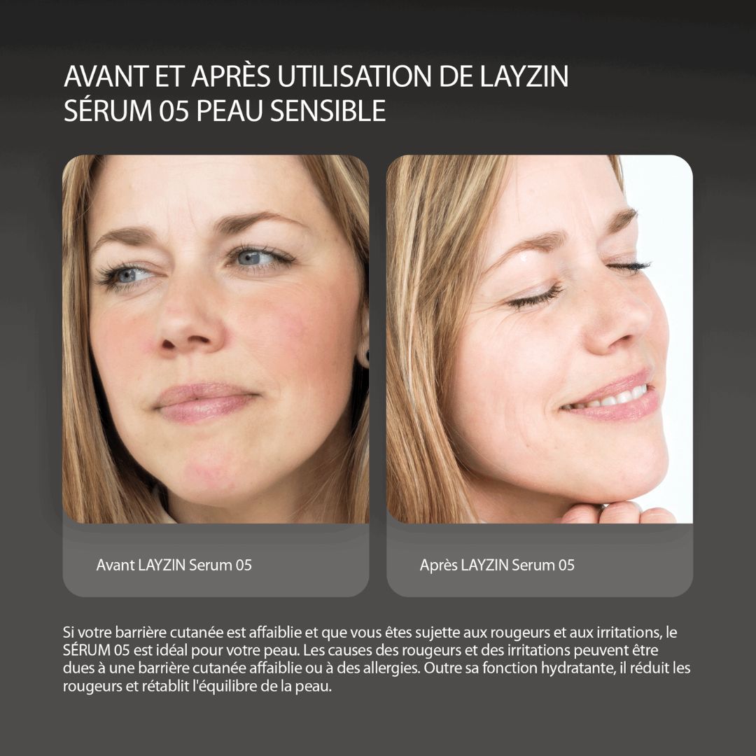 Image avant-après. Femme avec peau rouge, puis améliorée. Texte: Sérum 05 pour peau sensible.