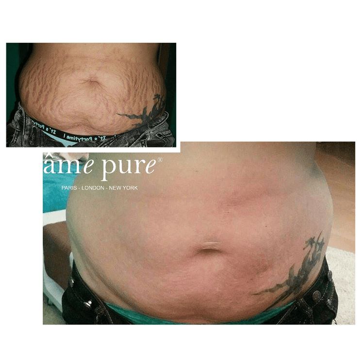 Comparaison avant-après des vergetures sur l'abdomen.