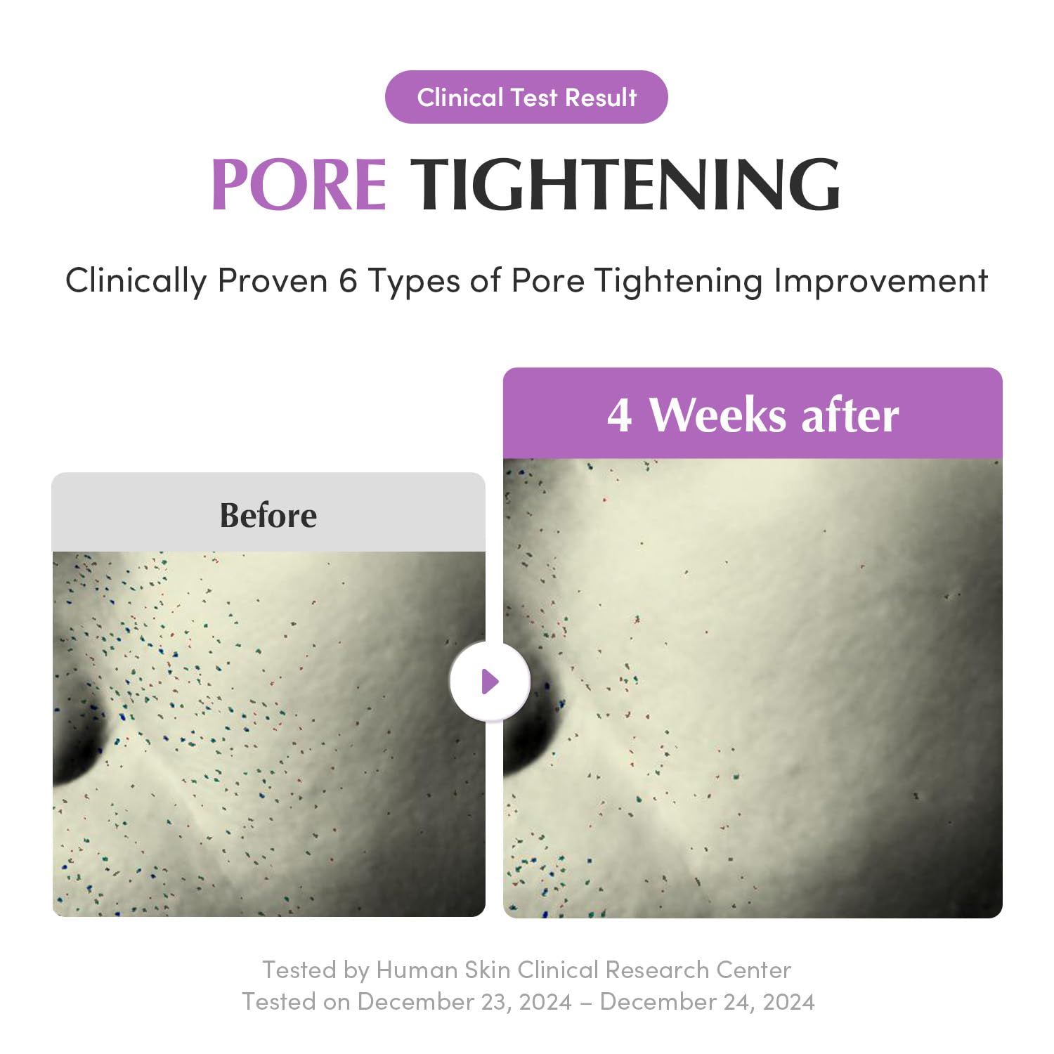 Comparaison avant-après. Peau avec pores avant et après 4 semaines de traitement. Texte: Pore Tightening. Testé cliniquement.