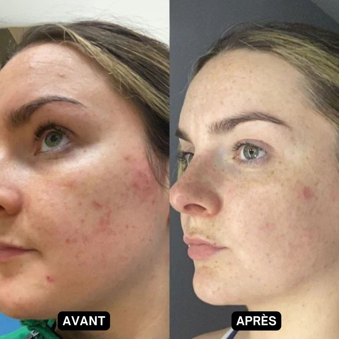 Photo avant-après d'une femme. Peau avec boutons et rougeurs. Après : peau nettement améliorée.
