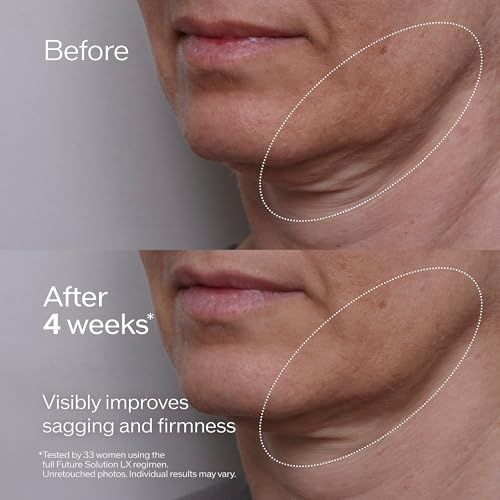 Comparaison avant-après. Zones du visage mises en évidence. Après 4 semaines: amélioration de l'affaissement et de la fermeté.