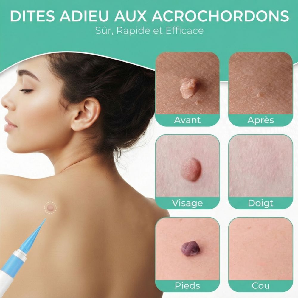 Images avant-après d'excroissances cutanées. Retrait avec un stylo. Femme avec excroissance dans le dos.