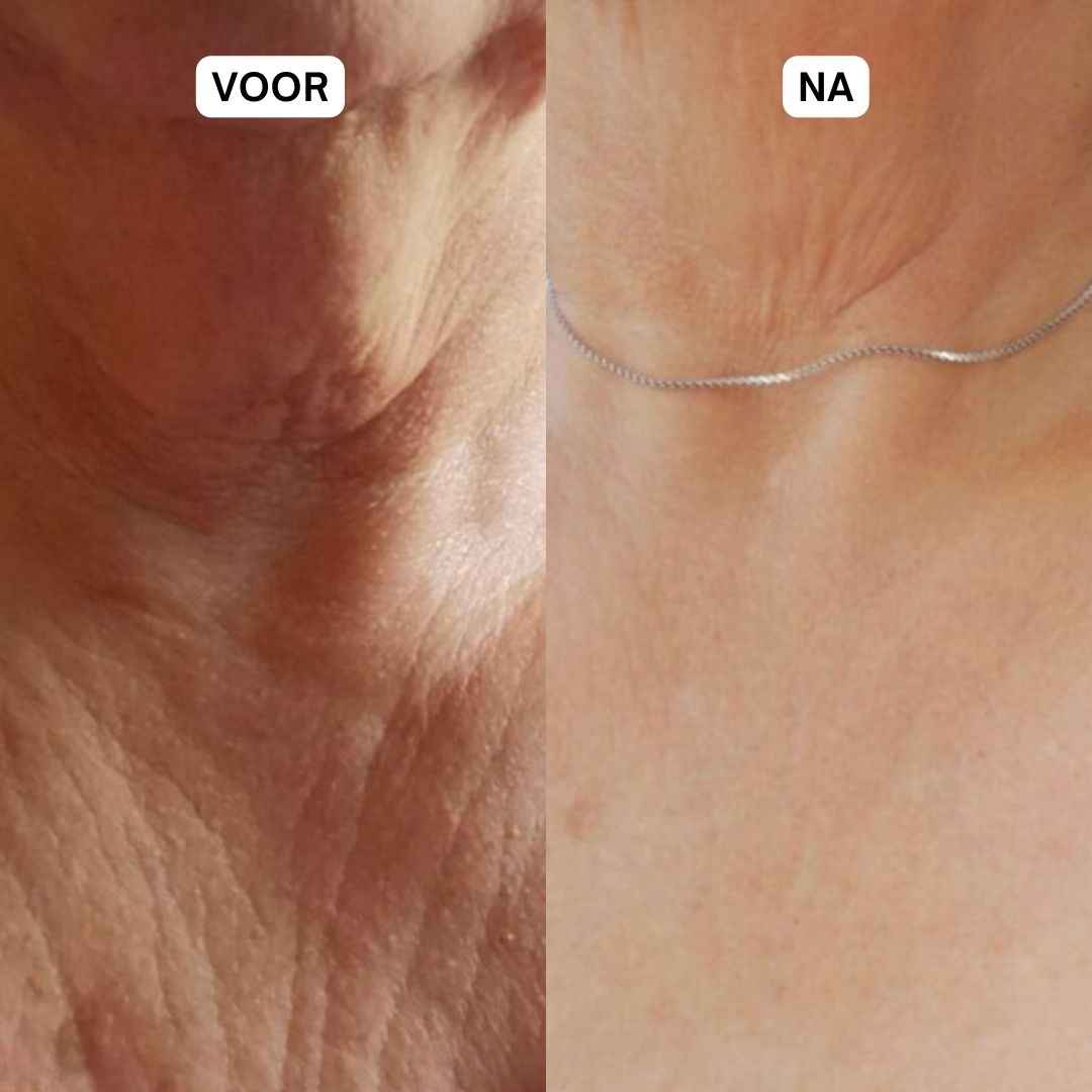 Voor- en na-vergelijking van de hals. Links: gerimpelde huid. Rechts: gladdere huid.
