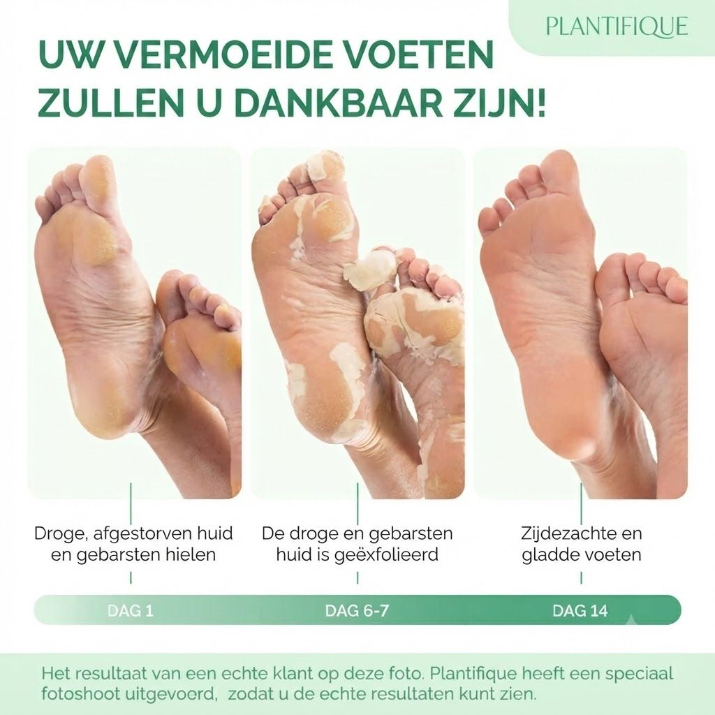 Drie afbeeldingen van voeten die droge, gebarsten huid tonen, gevolgd door afpelende huid en tot slot gladde voeten.