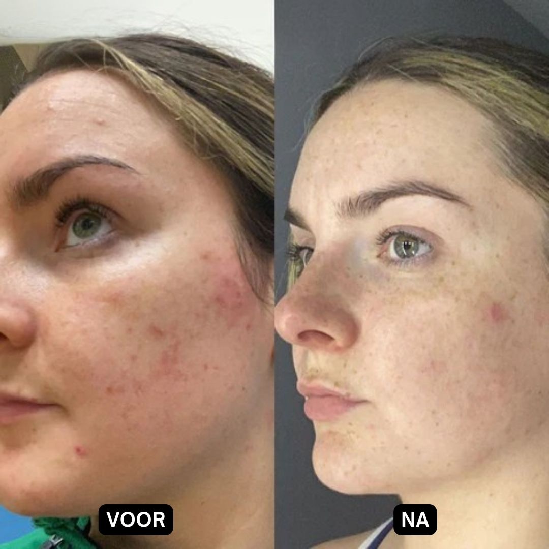 Voor- en nafoto van een vrouw. Huid met puistjes en roodheid. Na: duidelijk verbeterde huid.