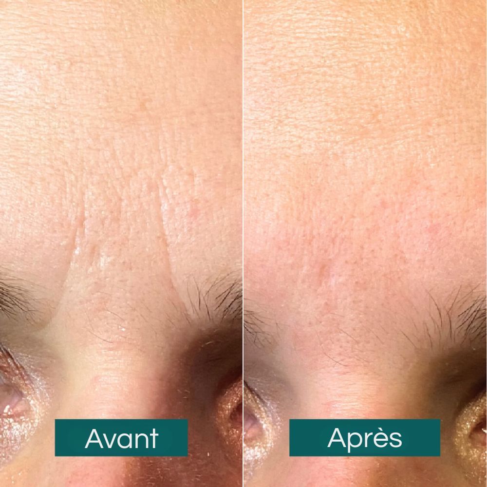 Comparaison avant-après des rides du front. Étiquettes : 'Avant' et 'Après'.