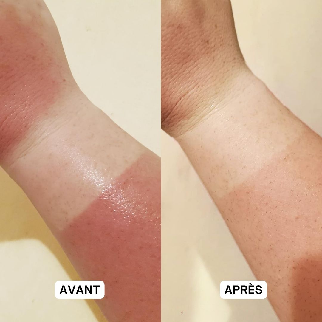 Deux bras. Gauche : peau brûlée par le soleil. Droite : peau après application. Texte : Avant, Après.