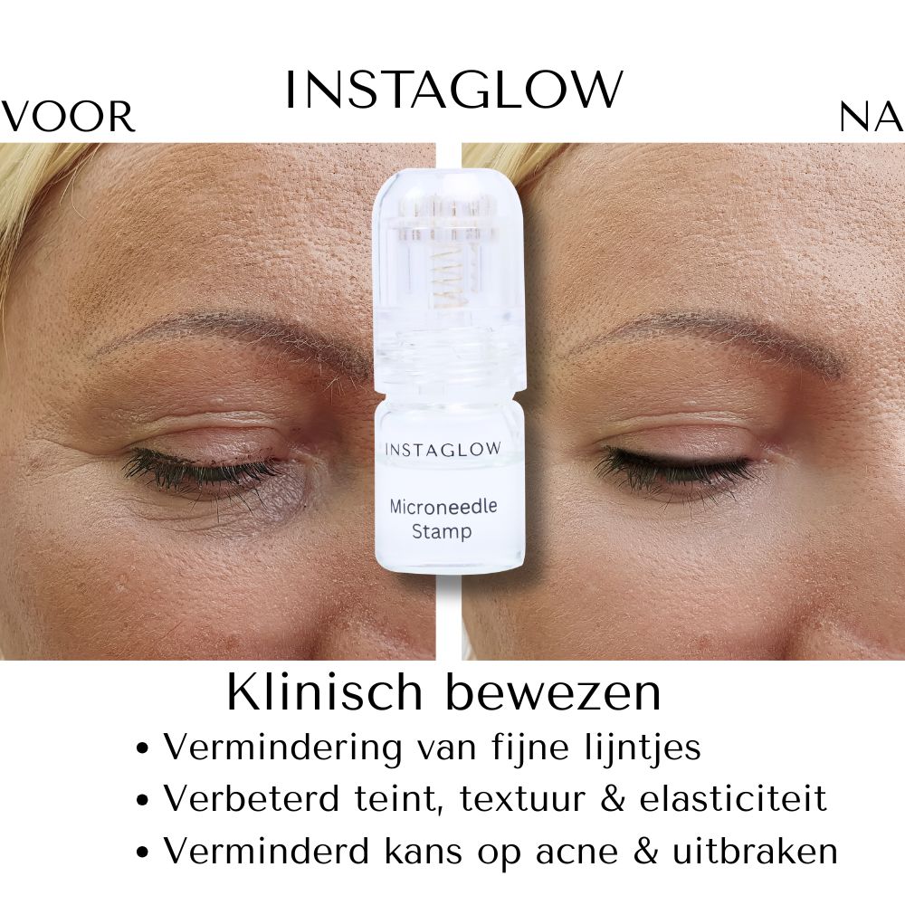 Voor- en na foto. Instaglow Microneedle Stamp. Vermindert rimpels, verbetert huidtextuur en elasticiteit.