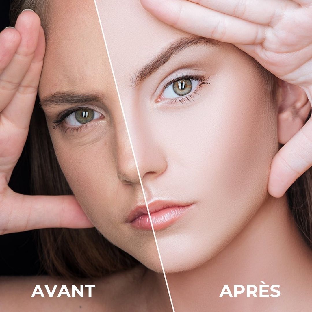 Comparaison avant-après. Visage d'une femme. Une moitié : imperfections. L'autre : peau lisse.
