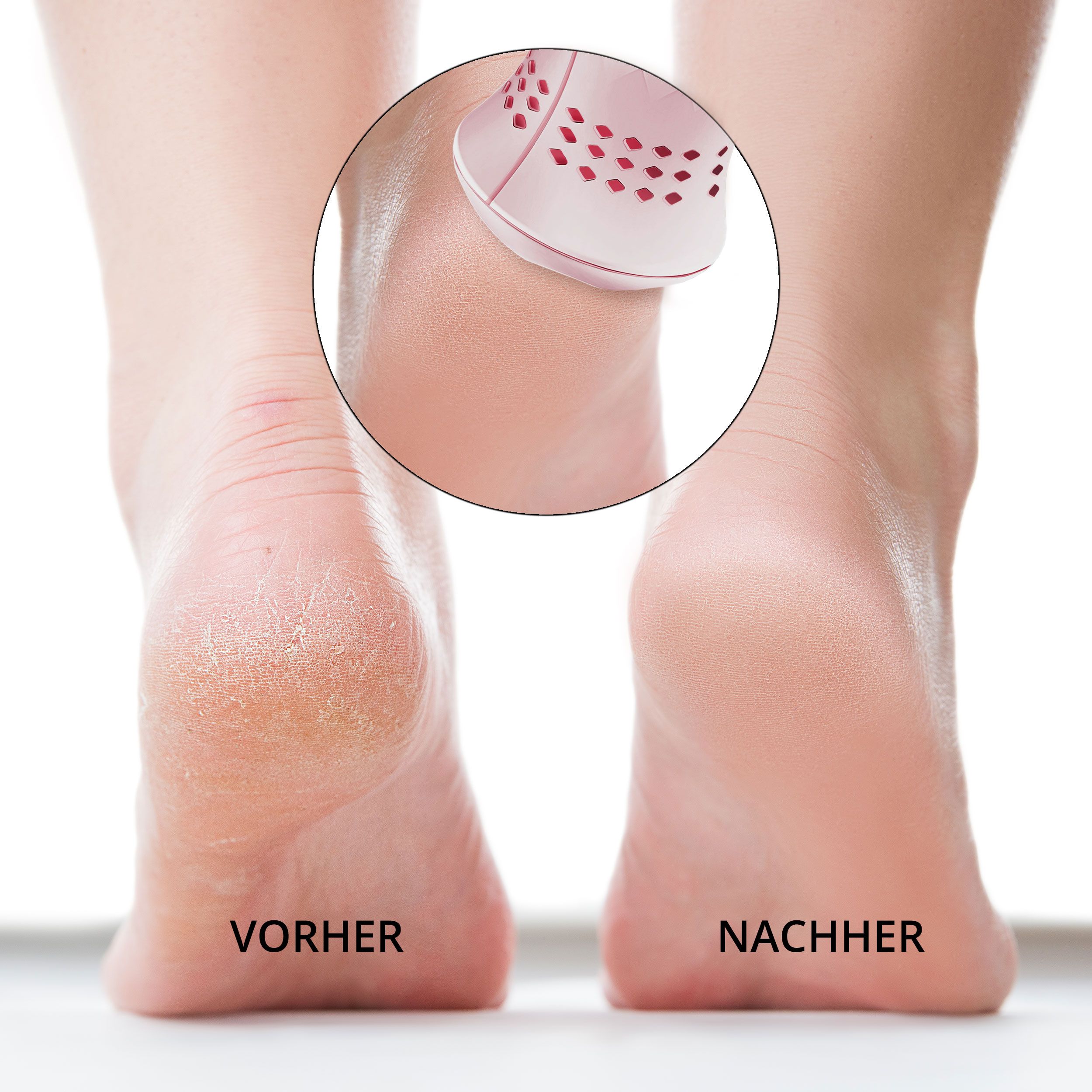 Pieds avant et après utilisation. En cercle: appareil. Texte: AVANT et APRÈS.