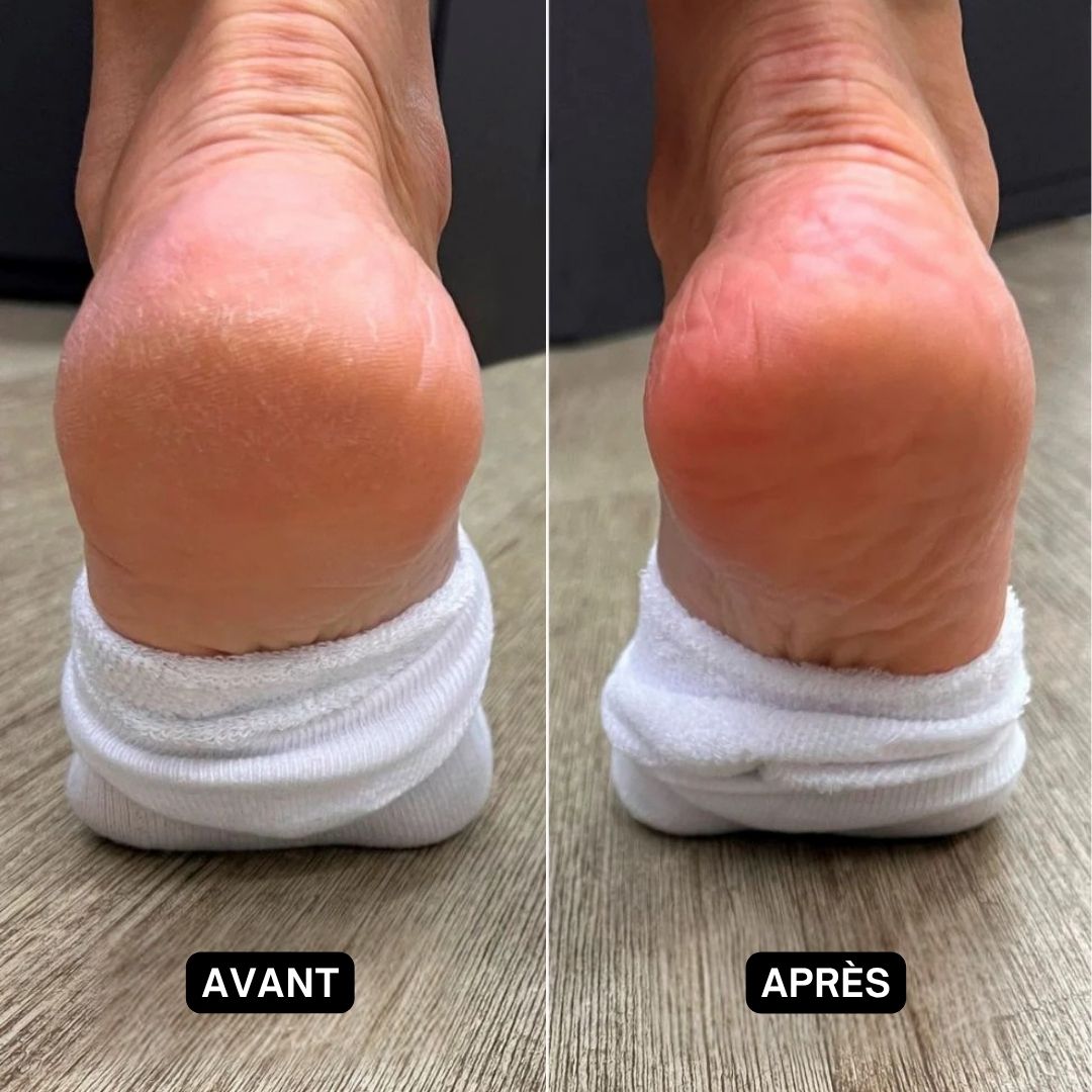 Image avant-après de talons. Le talon gauche est fissuré, le talon droit est lisse.