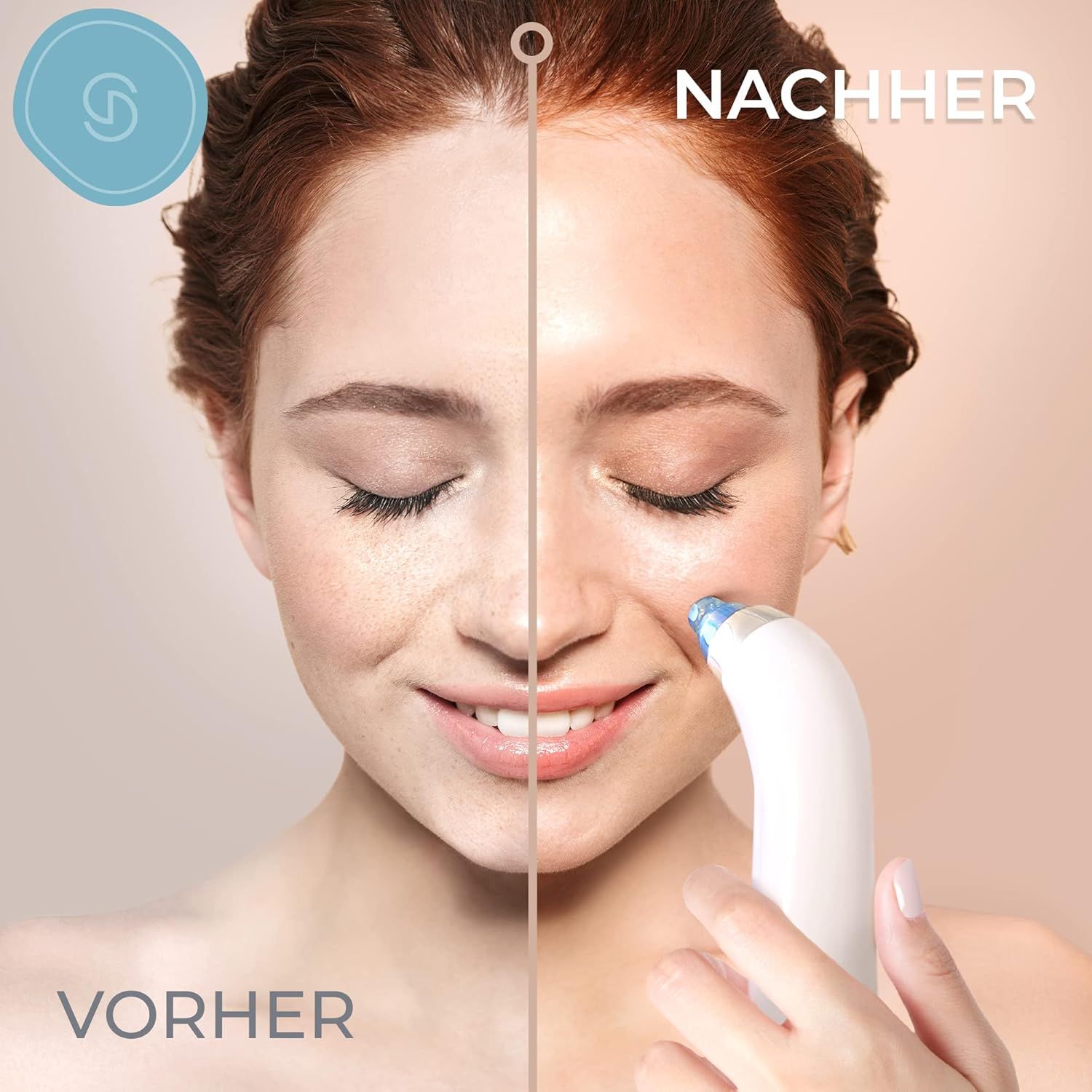 Voor-en-na vergelijking van de huid met de Essy Blackhead Remover.