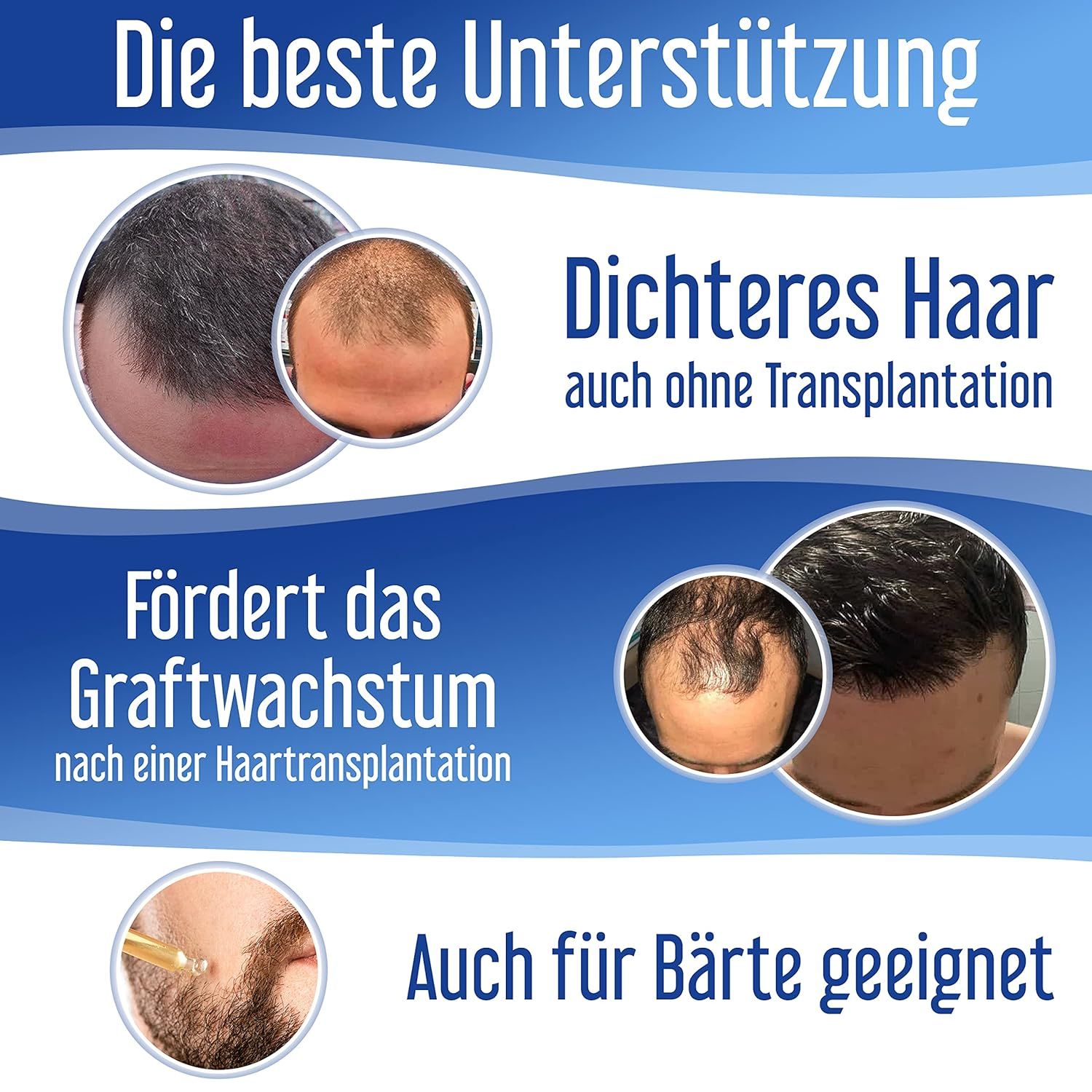 Hairforte Spray 3% Procapil contre la perte de cheveux, bloqueur de DHT