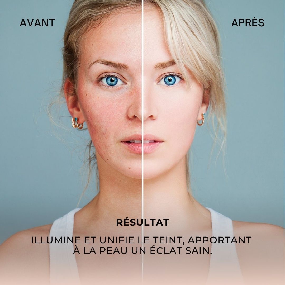Image avant-après. Visage avec imperfections, puis peau lisse. Texte : Résultat : Éclaircit et unifie le teint.
