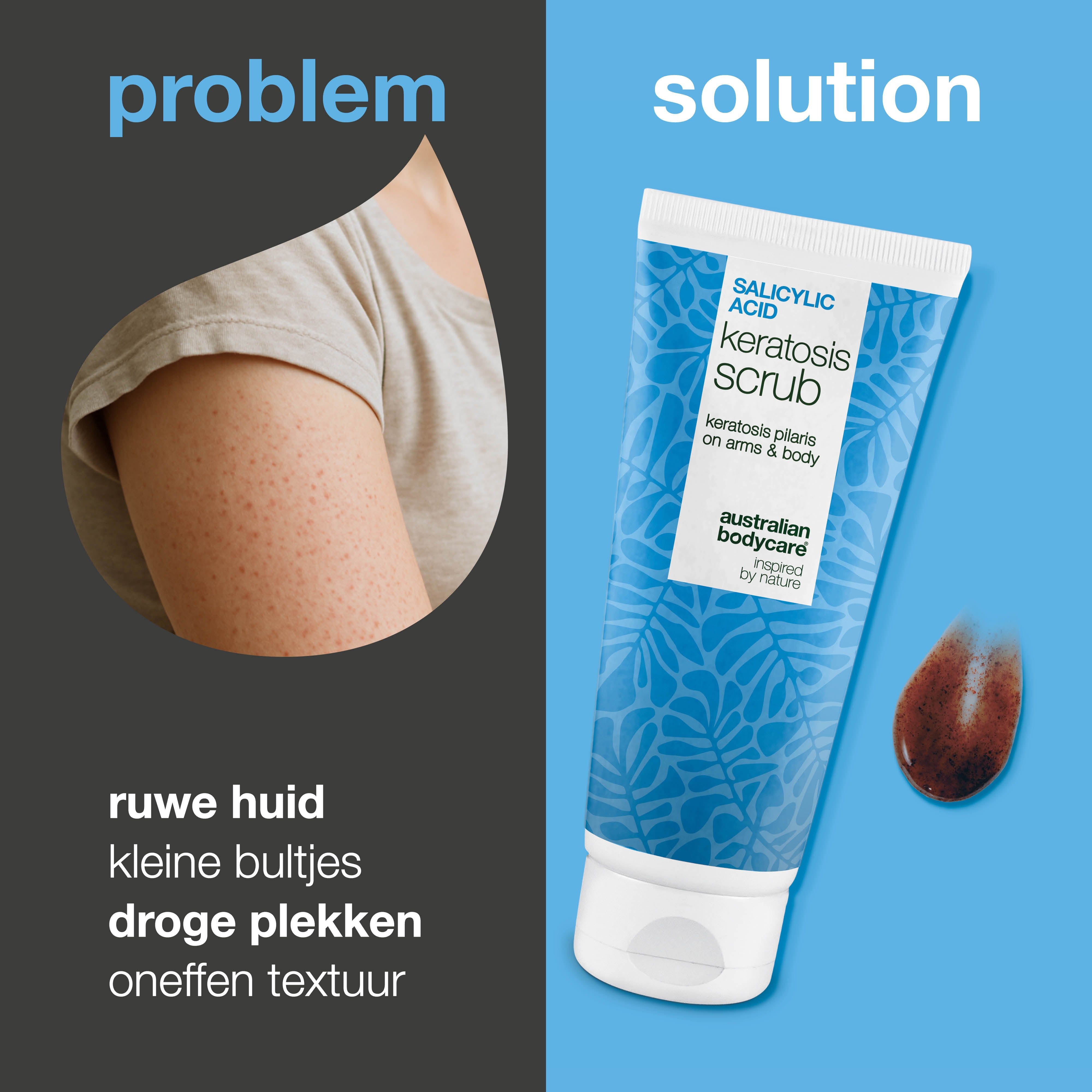 Arm met ruwe huid naast tube scrub. Tekst: keratosis pilaris on arms & body. Bruin scrubmonster.