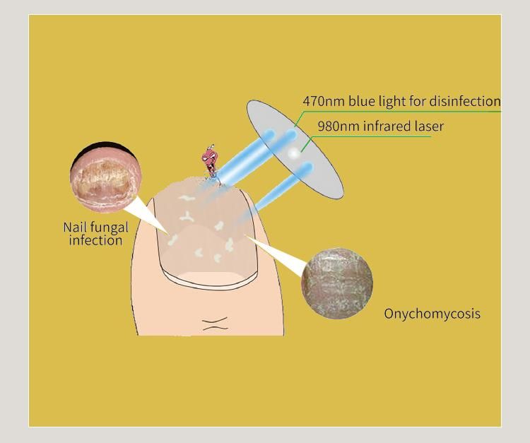 Diagram met een nagel die wordt behandeld door een apparaat met blauw licht en infraroodlaser. Labels: schimmelinfectie van de nagel, onychomycose.