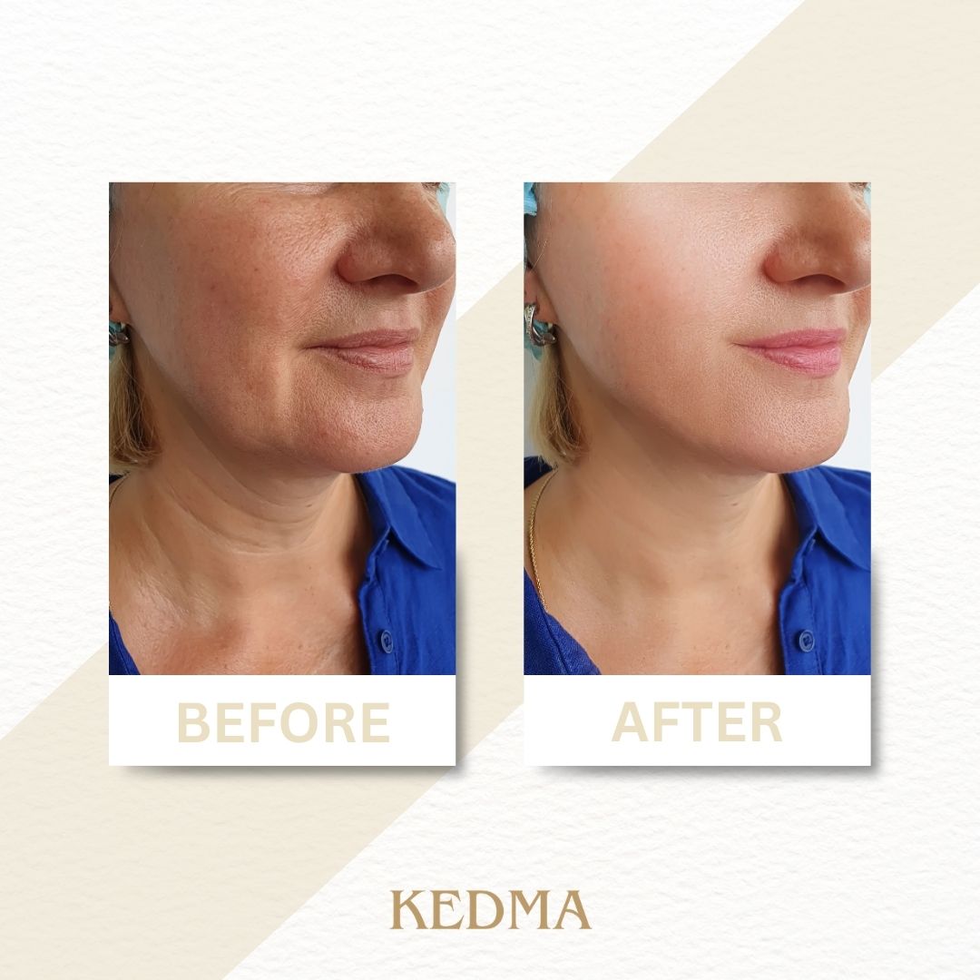 Kedma - Crème Collagène pour Cou et Décolleté aux Minéraux de la Mer Morte