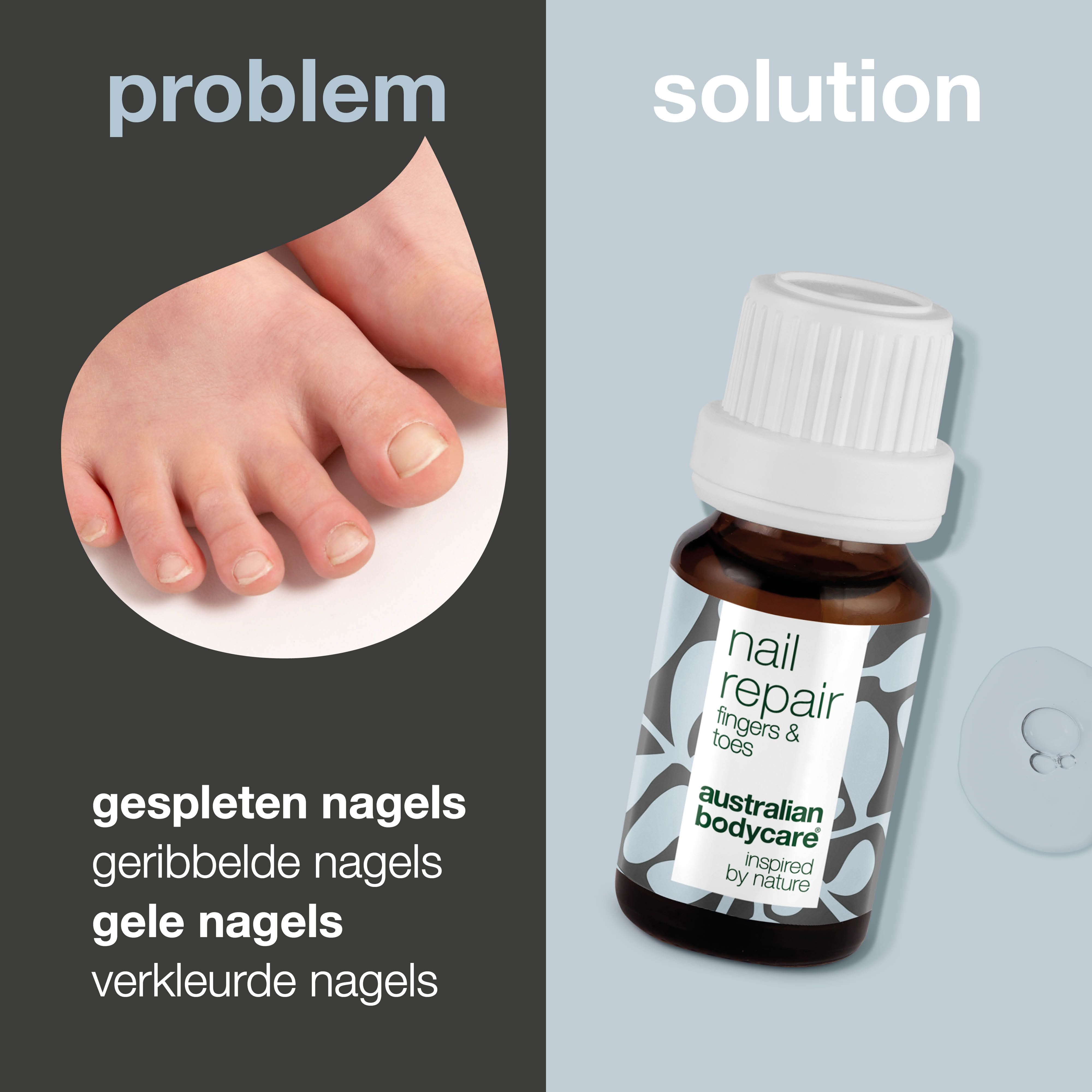 Probleem: voet met gespleten, geribbelde, gele en verkleurde nagels. Oplossing: flesje met "nail repair".