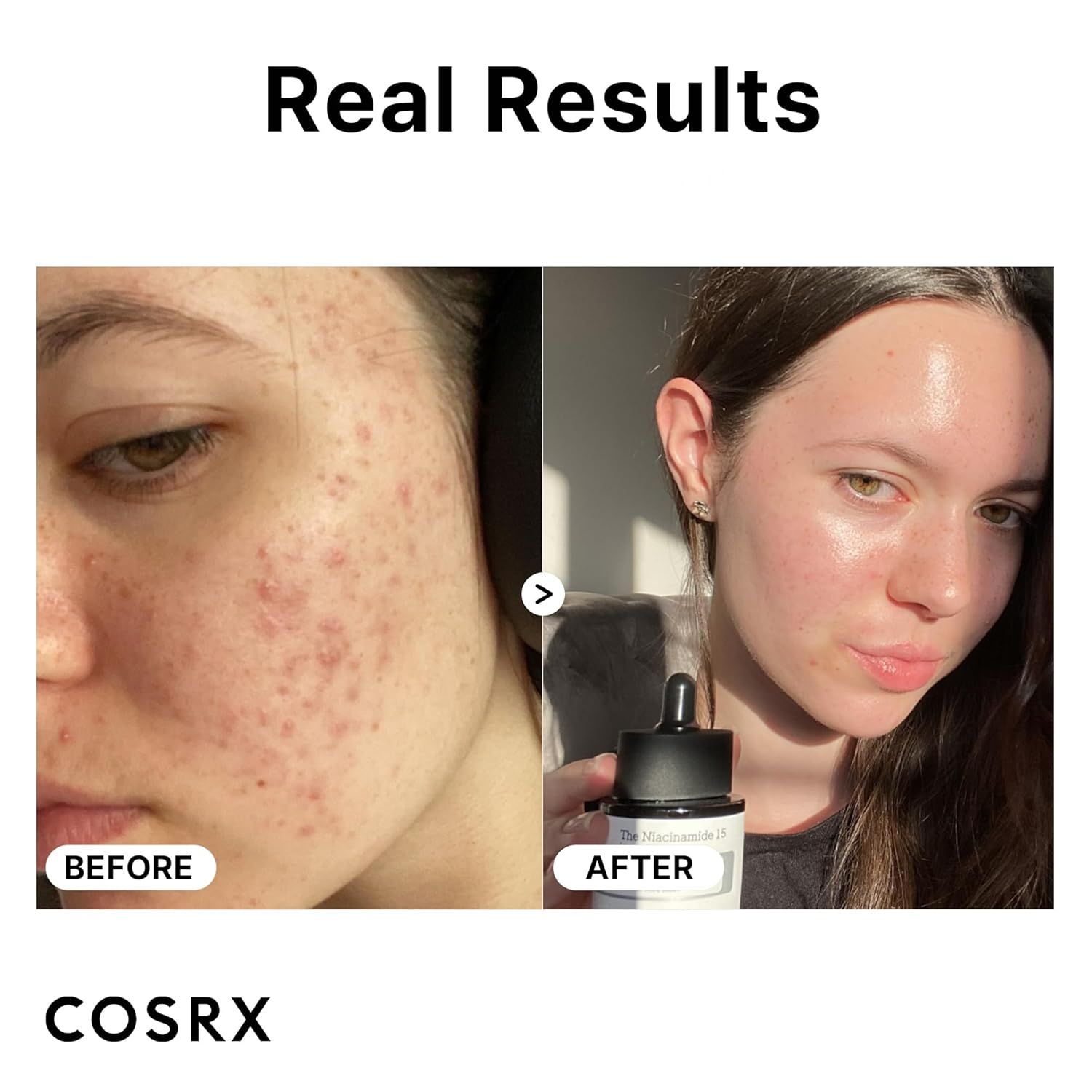 Comparaison avant/après de peau acnéique traitée avec le sérum COSRX Niacinamide 15.