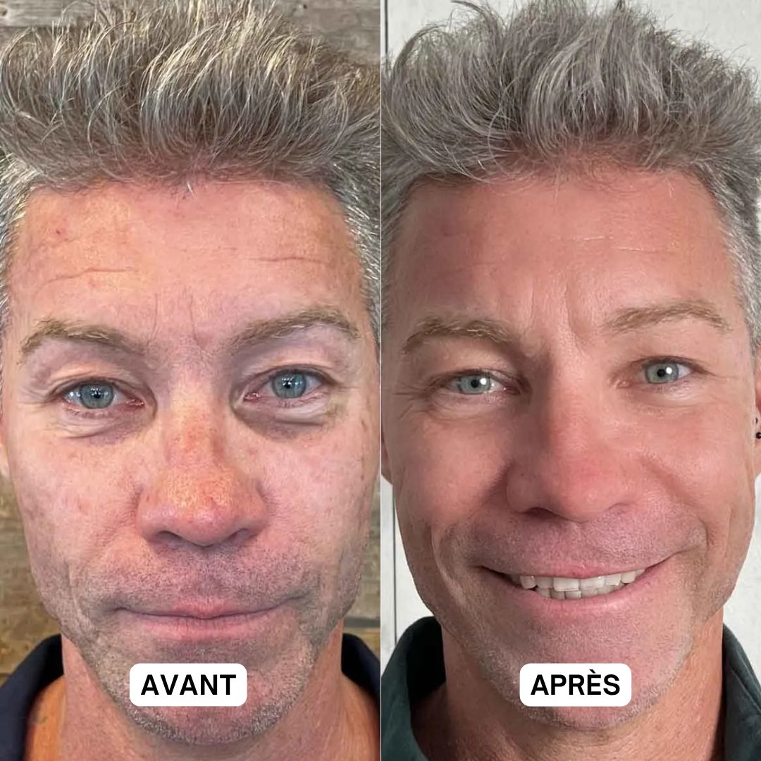 Comparaison avant-après. Homme avec rides, puis visage plus lisse. Pas d'informations sur le produit.