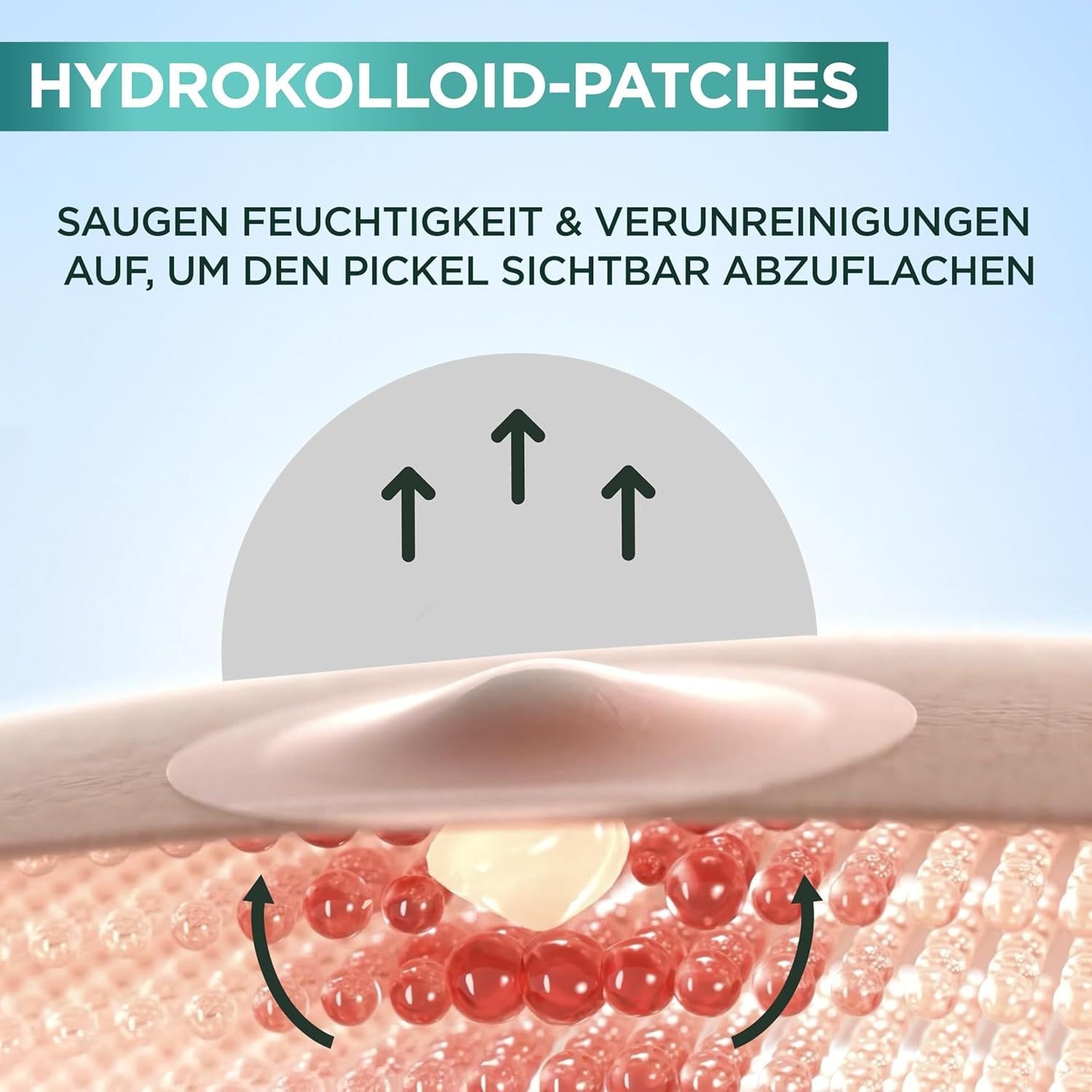 Gros plan d'un patch hydrocolloïde. Flèches indiquant l'absorption de liquide.
