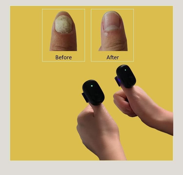 Comparaison avant/après d'un ongle; deux mains avec des appareils laser sur les pouces.
