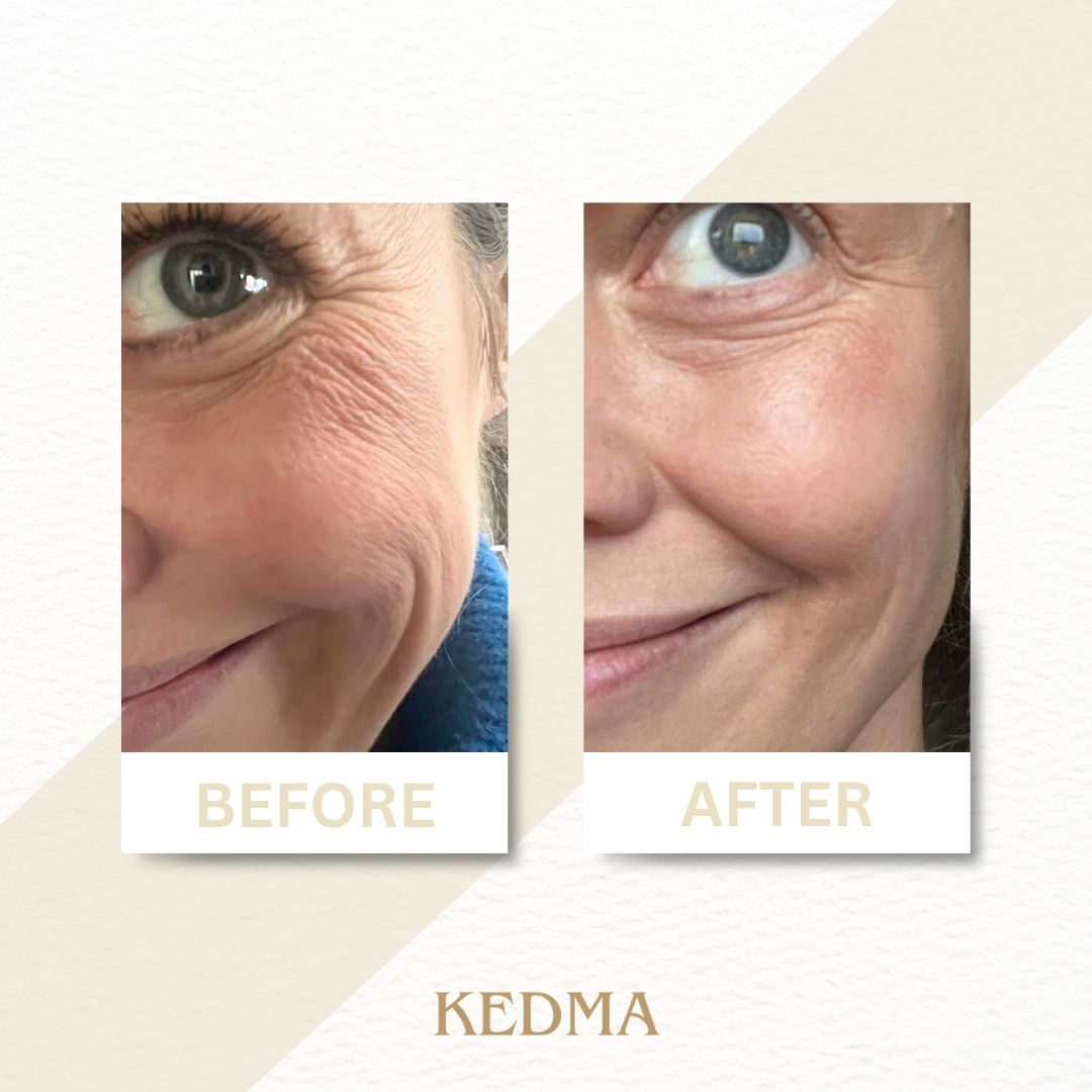 Kedma - Platinum Anti-Aging Serum met Q10 en Multivitaminen