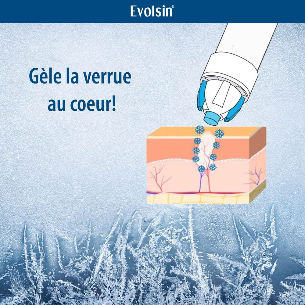 Illustration : Cryothérapie de la verrue jusqu'à la racine. Représentation du tissu cutané.